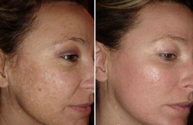 rajeunissement de la peau du visage au laser photos avant et après